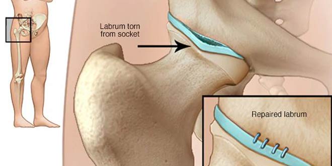 پارگی لابروم هیپ لگن