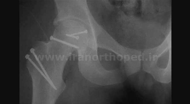 نمونه شکستگی سر استخوان ران (پیپکینز) در ناحیه لگن