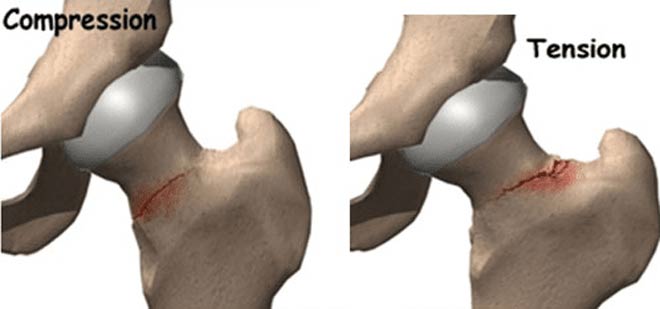 شکستگی استرسی مفصل ران چیست.علت، علائم و درمان