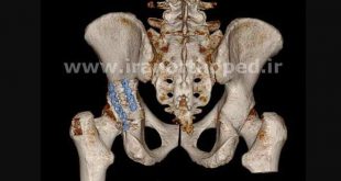 شکستگی عرضی استابولوم لگن