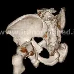 شکستگی لب خلفی استابولوم لگن
