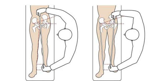 درمان کوتاهی پا با عمل جراحی تعویض مفصل ران و لگن