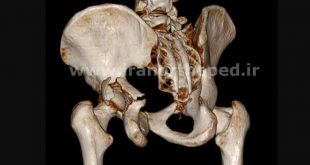 شکستگی لبه پشتی استابولوم لگن