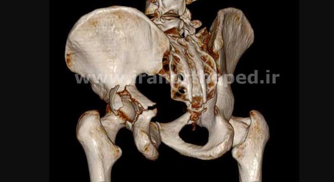 شکستگی لبه پشتی استابولوم لگن