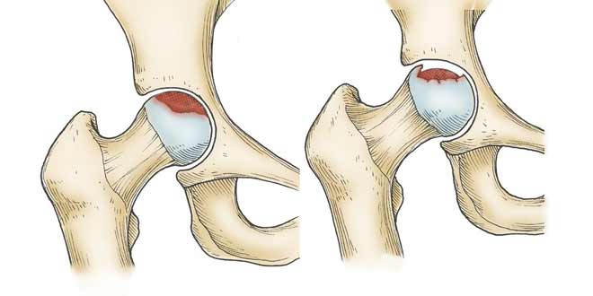 سیاه شدن سر استخوان ران در لگن