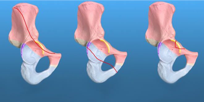 آیا شکستگی استابولوم در لگن نیاز به تعویض مفصل ران دارد
