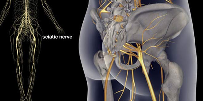 علائم و درمان آسیب عصب سیاتیك چیست