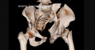 شکستگی ایلیوم و دررفتگی ساکروایلیاک لگن