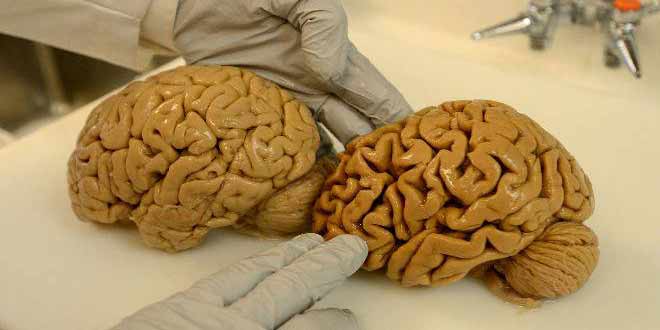 ده علامت الزایمر را بشناسیم