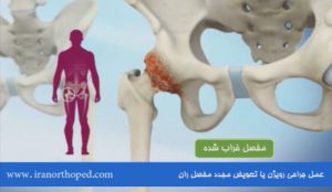 رویژن یا جراحی مجدد مفصل مصنوعی لگن