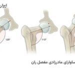 کوکسا وارا ی مادرزادی مفصل ران چیست
