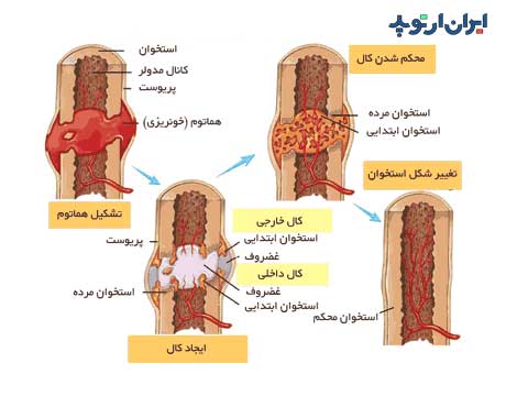 جوش خوردن شکستگی استخوان