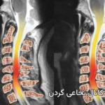 تنگی کانال نخاع گردن