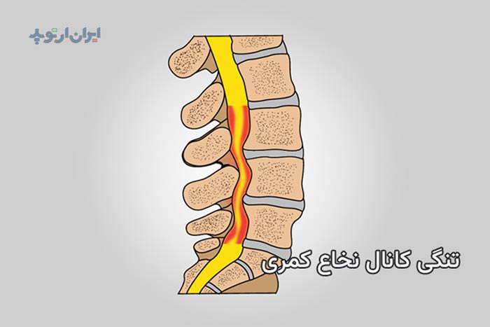 تنگی کانال نخاعی در گردن و کمر. علائم و درمان 15 درمان تنگی کانال نخاعی کمر