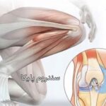 سندروم پلیکا در زانو چیست