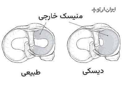علائم منیسک دیسکی شکل یا دیسکوئید و درمان آن 3 منیسک دیسکوئید