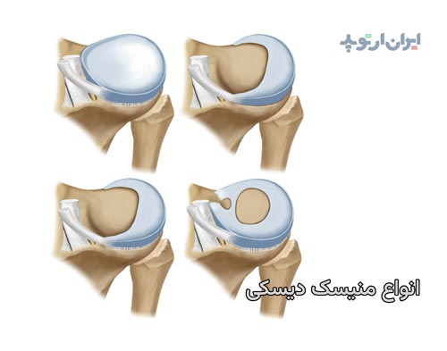 علائم منیسک دیسکی شکل یا دیسکوئید و درمان آن 2 انواع منیسک دیسکی شکل