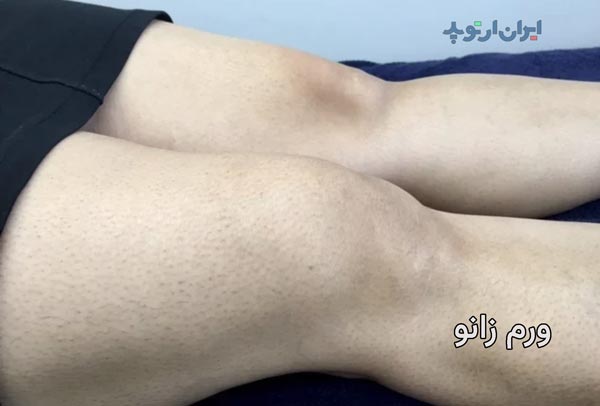 درمان آب آوردن زانو و ورم زانو 2 ورم زانو بدنبال آب آوردن زانو