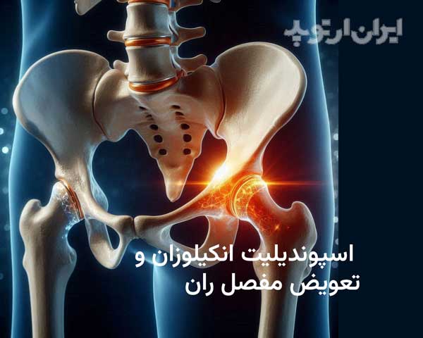 بیماریها و تعویض مفصل ران 21 اسپوندیلیت انکیلوزان و عمل تعویض مفصل ران