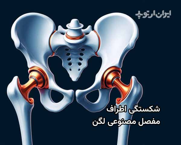 شکستگی اطراف مفصل مصنوعی لگن 5 شکستگی اطراف مفصل مصنوعی
