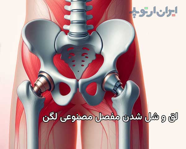 لق و شل شدن مفصل مصنوعی لگن 5 لق و شل شدن مفصل مصنوعی لگن