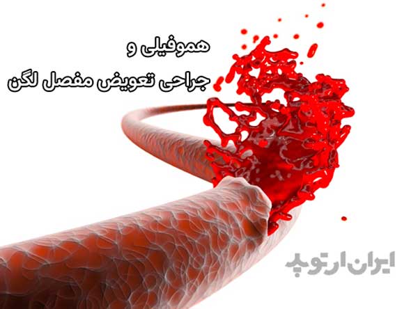 بیماریها و تعویض مفصل ران 19 هموفیلی و عمل تعویض مفصل ران