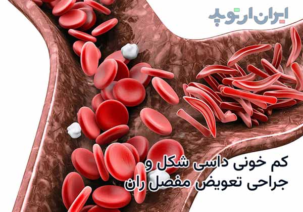 بیماریها و تعویض مفصل ران 15 کم خونی داسی شکل و عمل تعویض مفصل ران