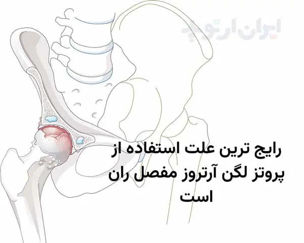 پروتز لگن چیست 2 رایج ترین علت استفاده از پروتز لگن آرتروز مفصل ران است