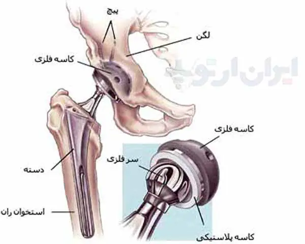 پروتز لگن چیست 3 یگ پروتز ران و لگن