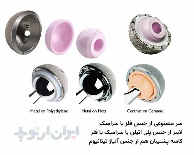 پروتز لگن چیست 6 سر مصنوعی از فلز یا سرامیک و لاینر از پلی اتیلن است