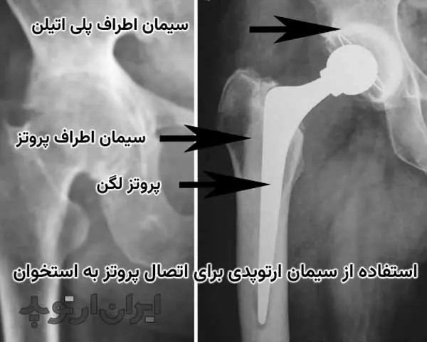 پروتز لگن چیست 5 استفاده از سیمان ارتوپدی برای اتصال پروتز به استخوان