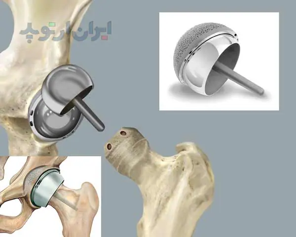 پروتز لگن چیست 7 تعویض سطح سر پروتز لگن