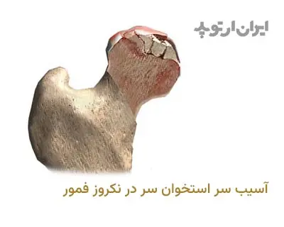  تغییر شکل بدنبال سیاه شدن سر استخوان ران