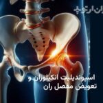 اسپوندیلیت انکیلوزان و جراحی تعویض مفصل