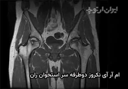 عکس سیاه شدن استخوان لگن در ام آر آی. ضایعه نکروز در سر استخوان ران