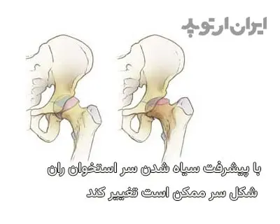 تغییر شکل و تخت شدن سر استخوان ران بعد از سیاه شدن استخوان لگن