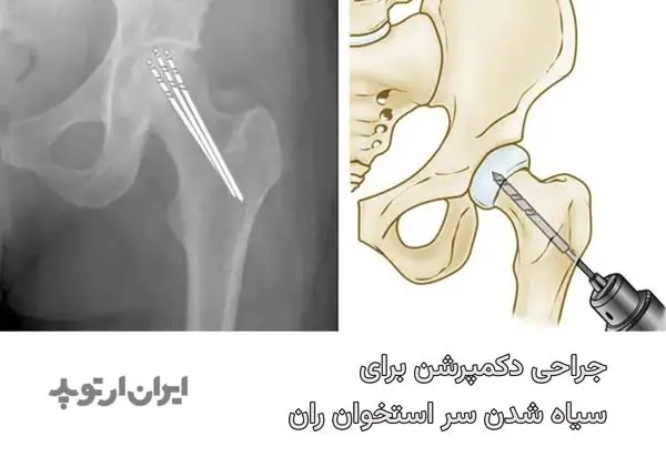 جراحی دکمپرشن برای درمان سیاه شدن لگن