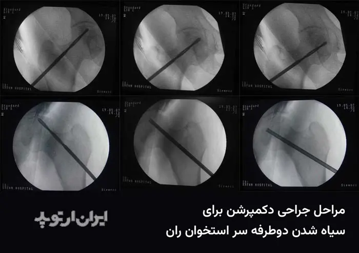عکس دکمپرشن سر استخوان ران روی مانیتور سی آرم حین جراحی