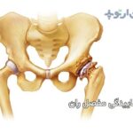 آرتروز و ساییدگی در مفصل ران چیست و چگونه درمان میشود