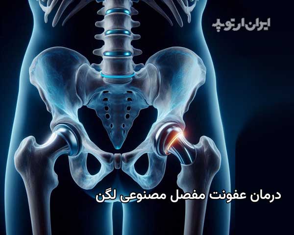 تشخیص و درمان عفونت مفصل مصنوعی کارگذاشته شده در لگن چگونه است