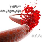 هموفیلی و جراحی تعویض مفصل