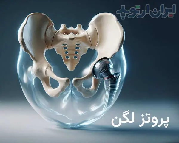 پروتز لگن چیست 1 پروتز لگن چه ساختمانی و چه انواعی دارد و در کجا استفاده میشود