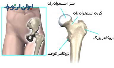 سر استخوان ران و تروکانتر بزرگ و کوچک ران