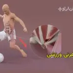 هرنی یا فتق ورزشی چیست