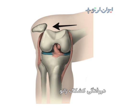 در رفتگی کشکک زانو و درمان آن 7 در رفتگی کشکک زانو