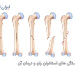شکستگی های استخوان ران و فمور و درمان