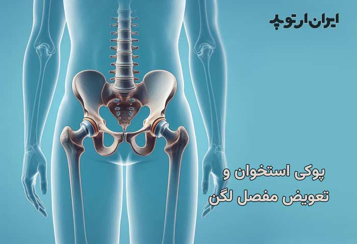 بیماریها و تعویض مفصل ران 23 پوکی استخوان و عمل تعویض مفصل ران
