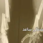 شکستگی ساعد