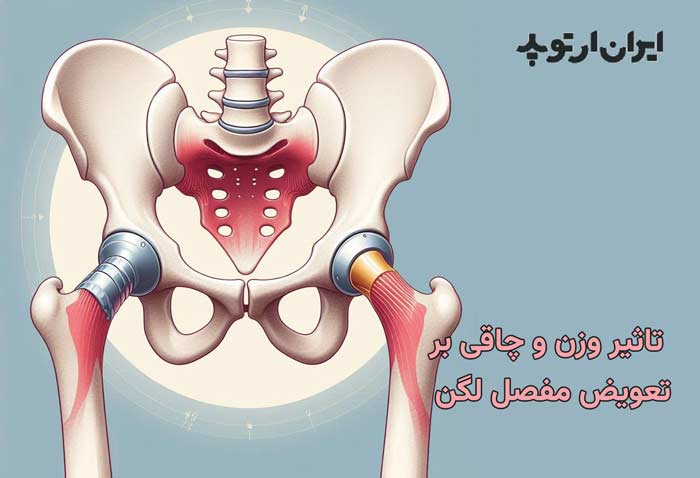 تاثیر وزن و چاقی بر تعویض مفصل لگن