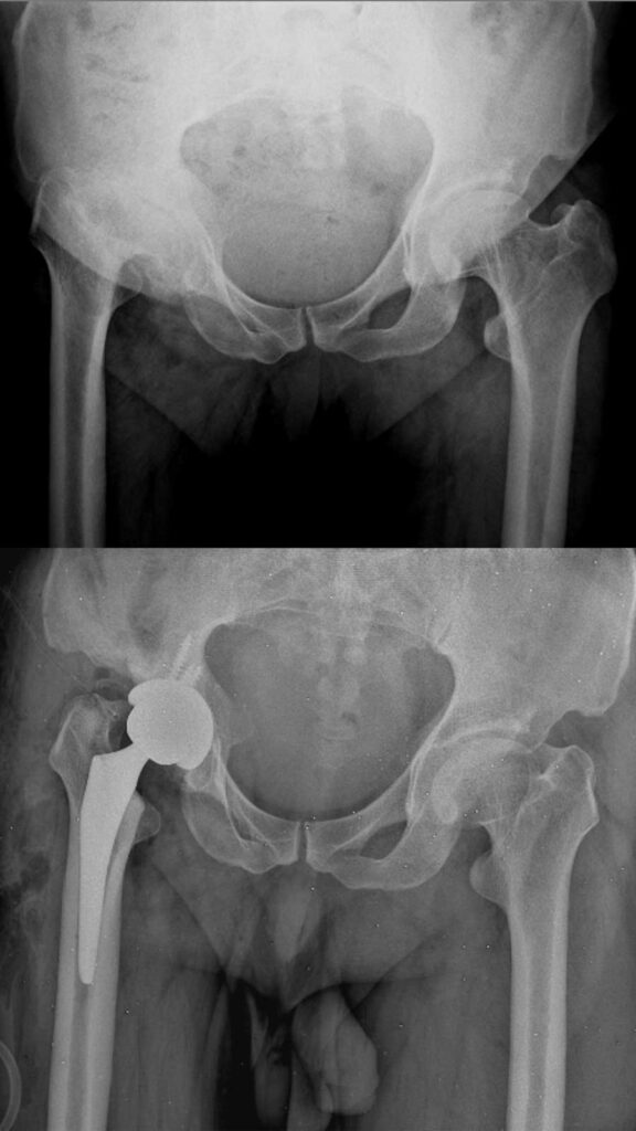 تعویض مفصل لگن بهترین راه درمان خرابی مفصل ران 34 عکس تعویض مفصل لگن